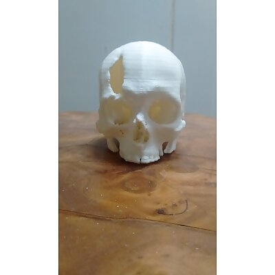 Cráneo con fractura en hueso frontal tomografía computada